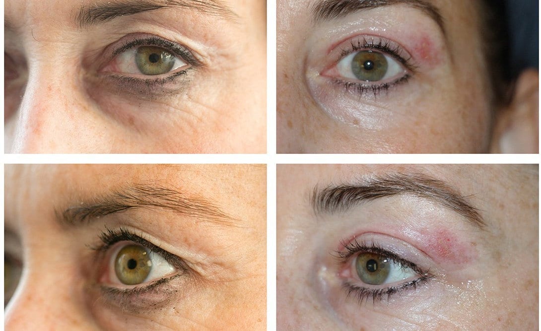 Plasma Pen Fibroblasting For Wrinkles, Sagging, and Scars