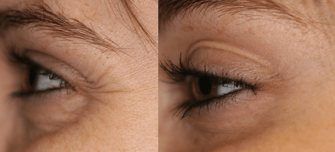 plasma-pen-eye2