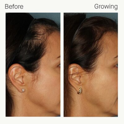 Before & Growing – Tyler, 6 months