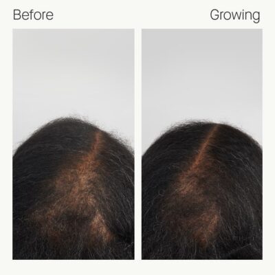 Before & Growing – Wendy, 6 months (back view)