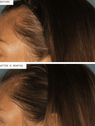Nutrafol Women – Laura, 6 months