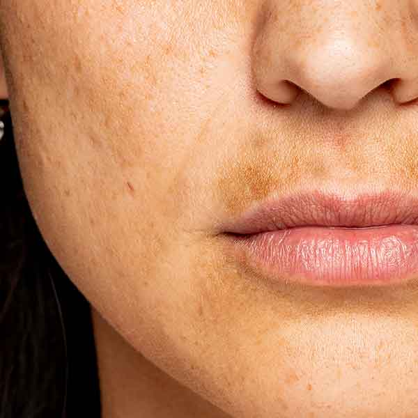 Dark spots on the skin: Causes, treatments, and remedies