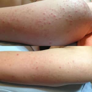 Body Acne Treatments