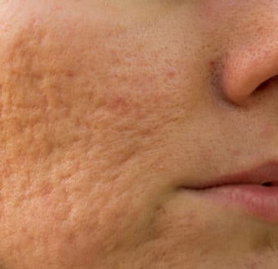 acne scar treatment scottsdale