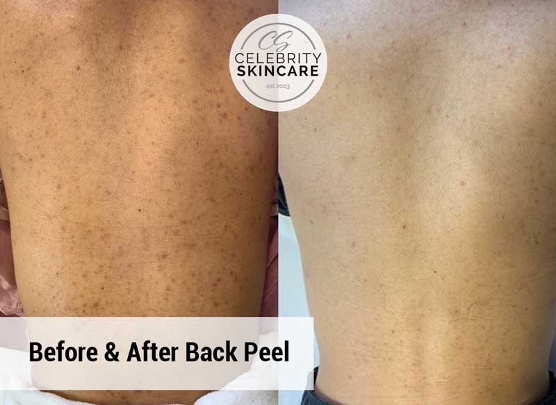 Back Acne Scars: Treatments and Chemical Peels