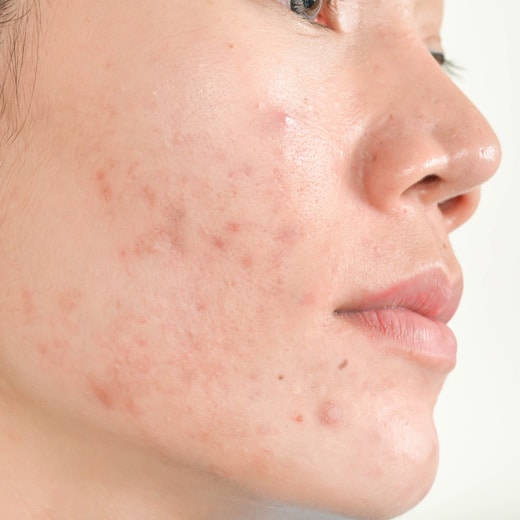 acne treatment scottsdale 