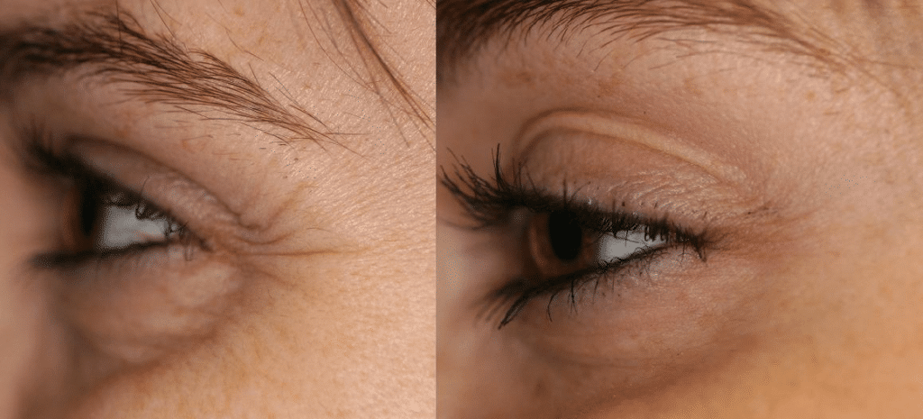 plasma pen for eyes before and after