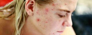 adult acne causes and treatment women over 30 Celebrity Skin Scottsdale
