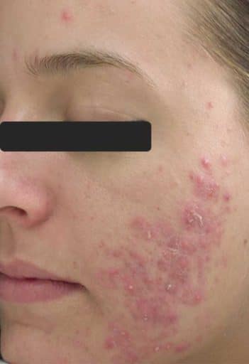 acne treatment scottsdale before 