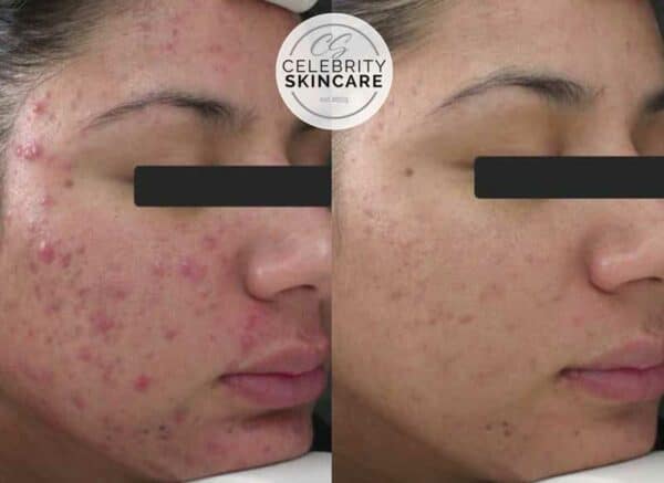 acne treatment scottsdale