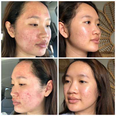 asian skincare chemical peel acne scarring