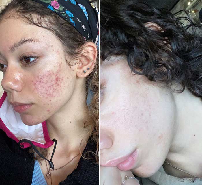 chemical peels before and after women of color