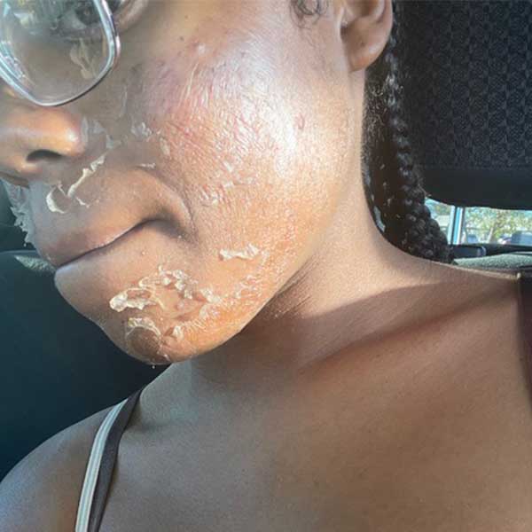 dark skin chemical peel