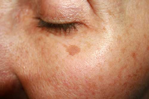 brown spots sun spots treatment scottsdale