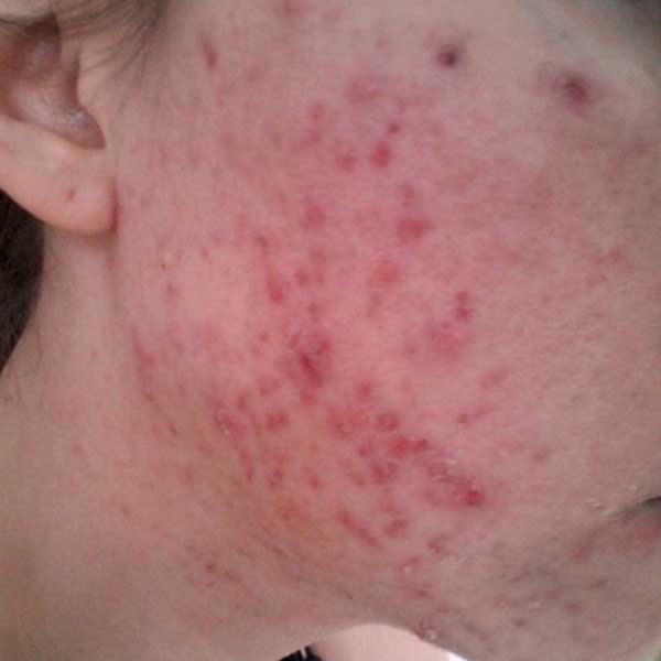 acne scarring treatment scottsdale