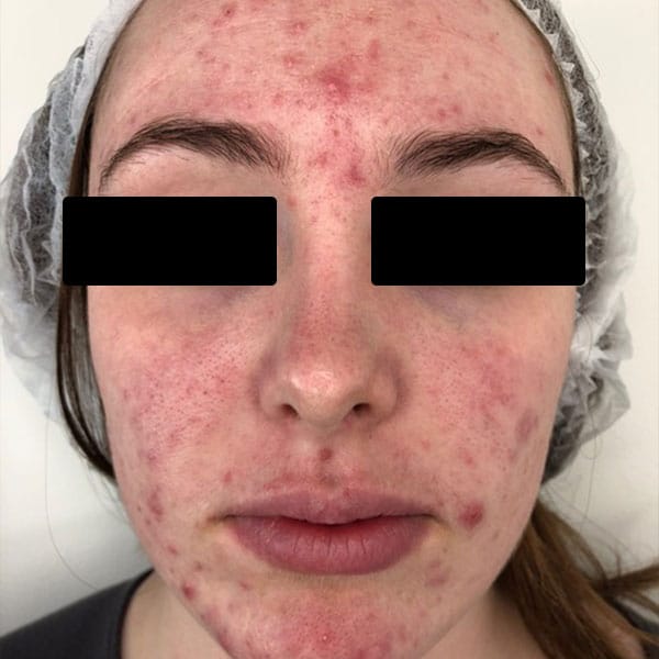 cystic inflammatory acne treatment scottsdale