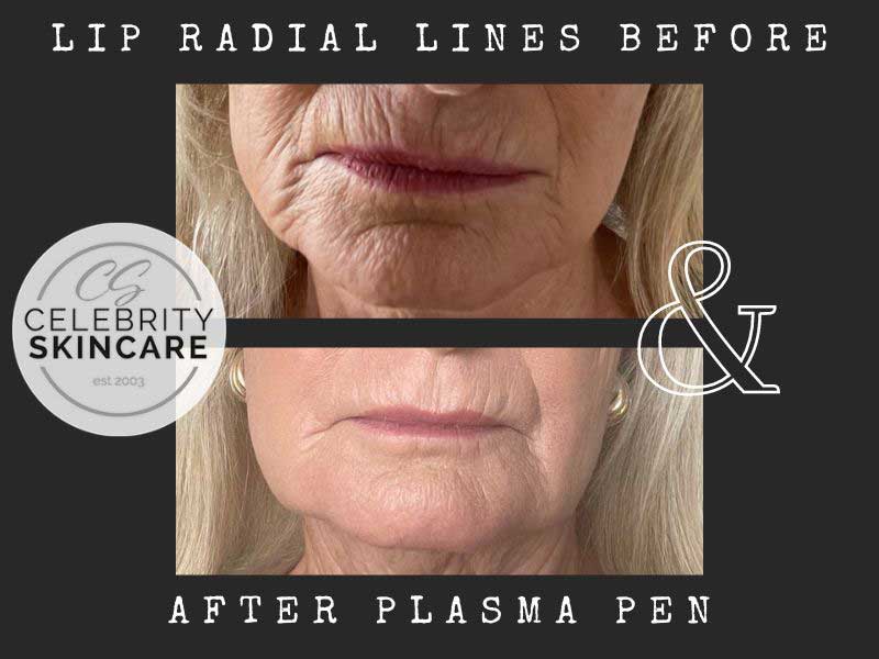 Skin Tightening Plasma Fibroblast  Rejuvenate & Shrink Your Skin — OC  BEAUTY CO Permanent Makeup & Skin Treatments