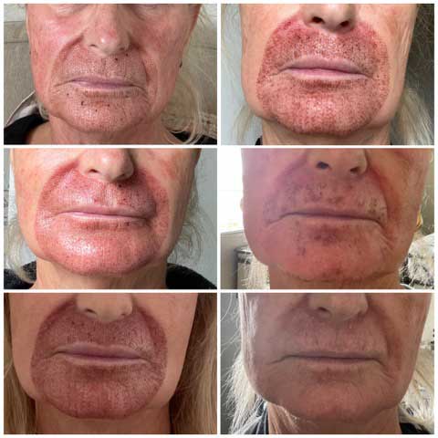 Plasma Pen Fibroblasting For Wrinkles Sagging and Scars