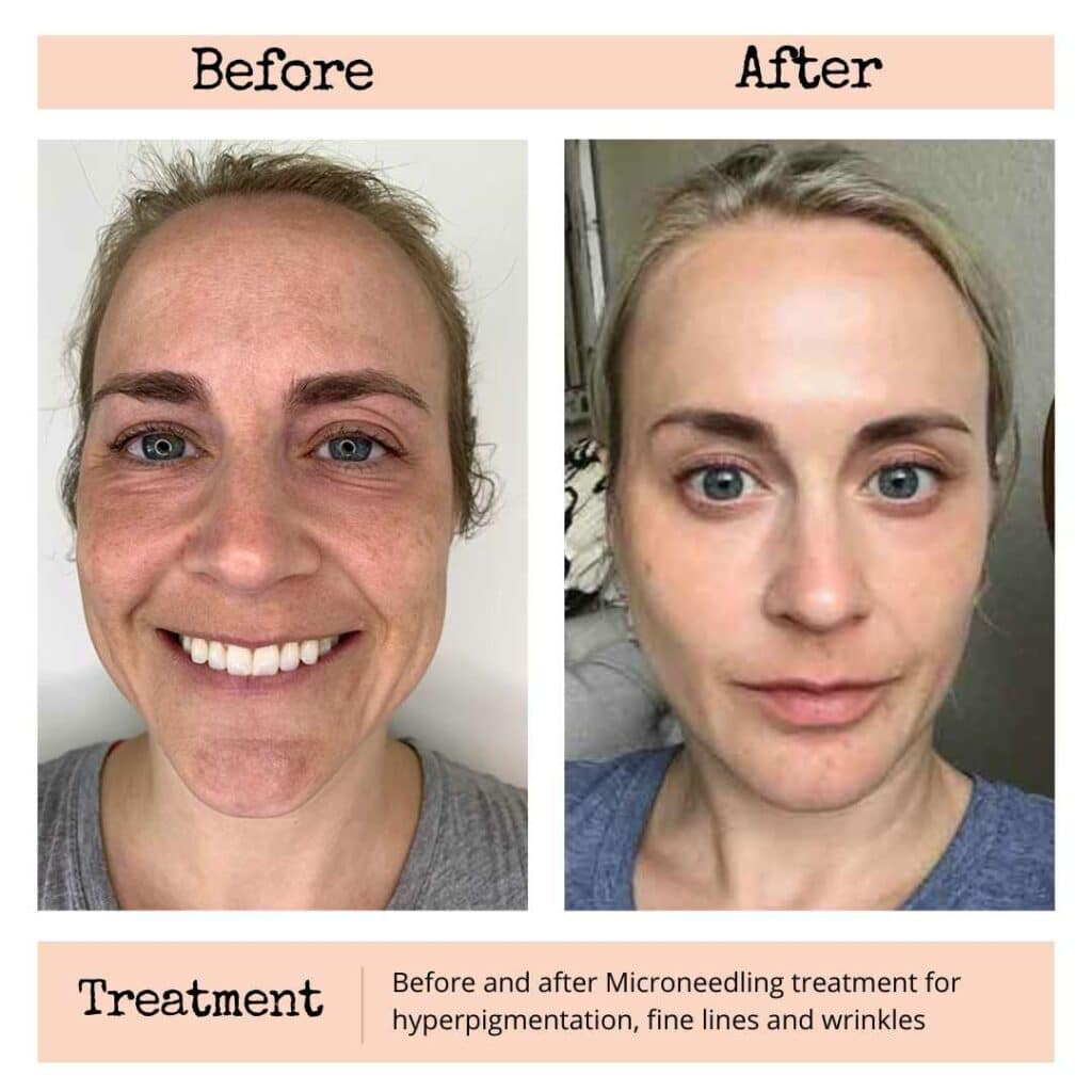 Face Before And After Microneedling Face Before And After Microneedling