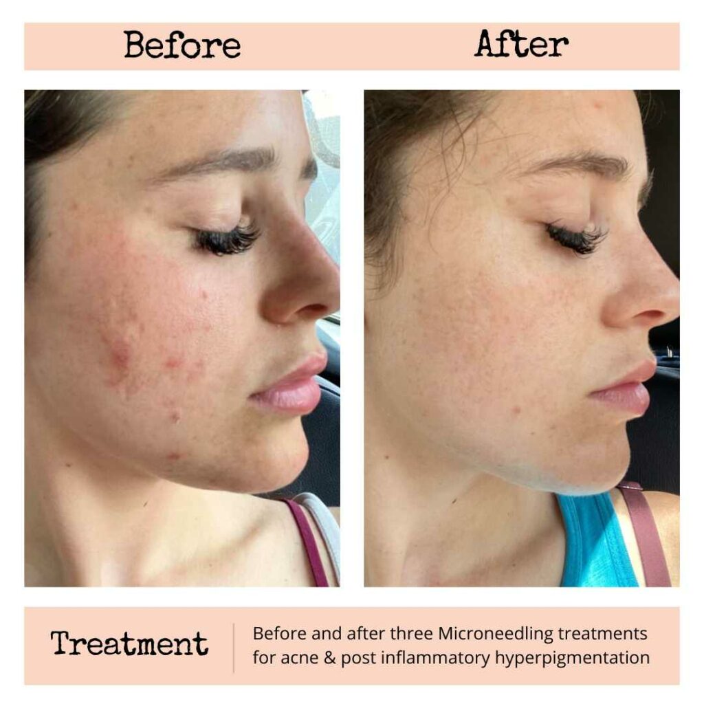 microneedling for acne and PIH