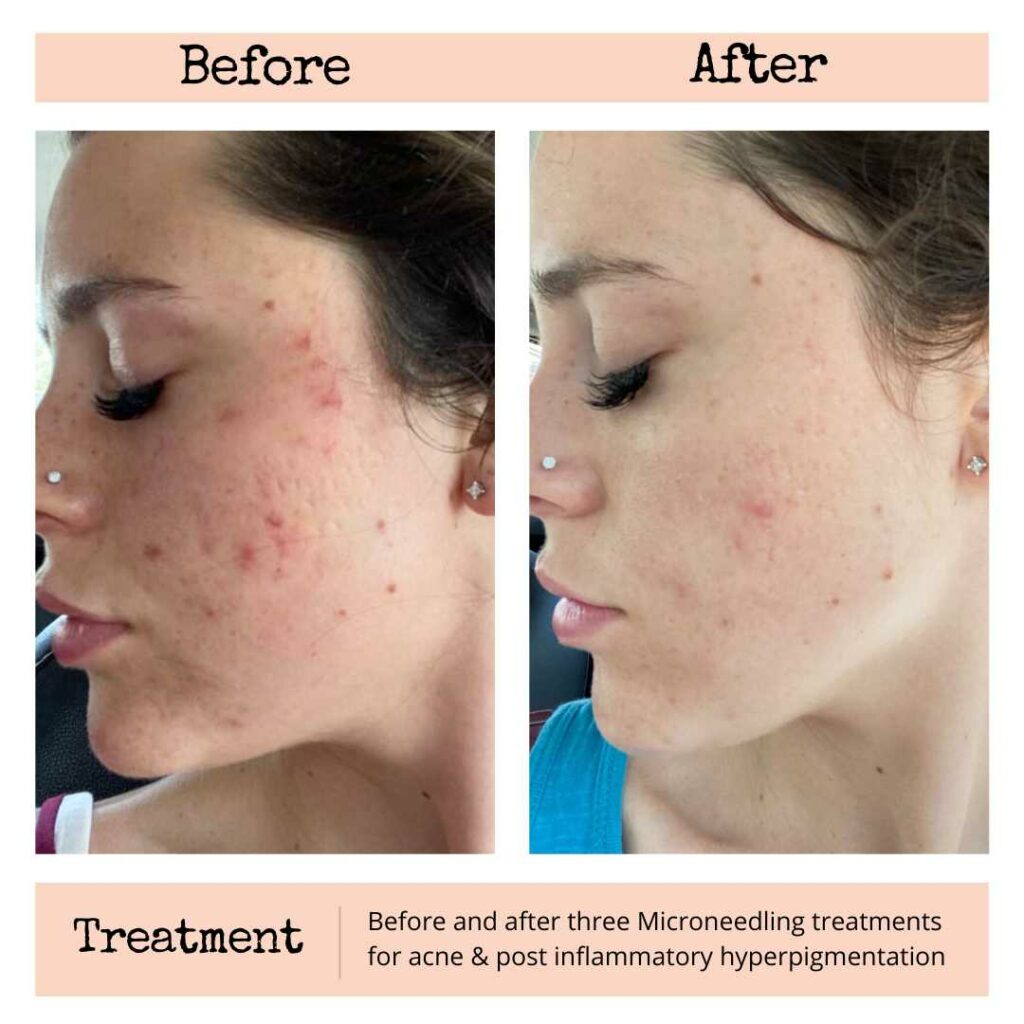 before and after microneedling for acne