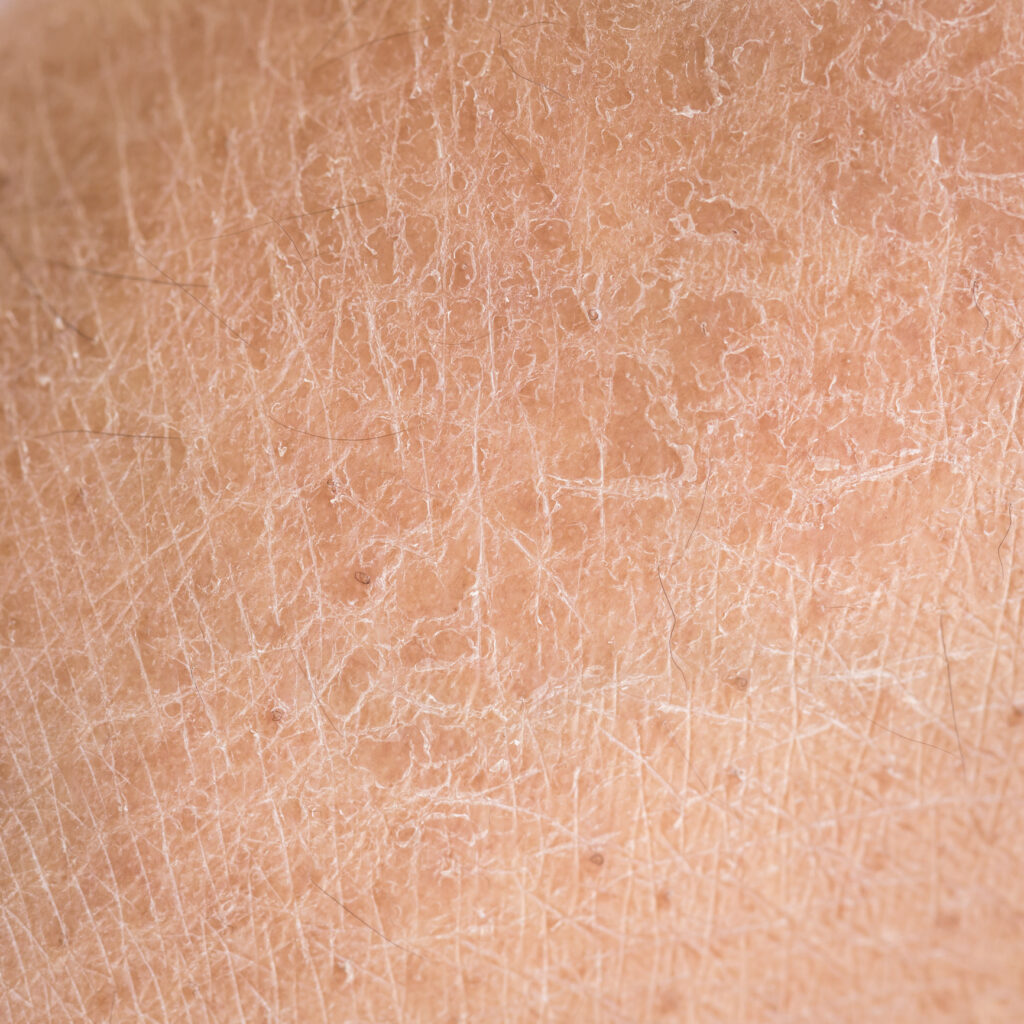 dry skin from unfiltered water and environmental exposure