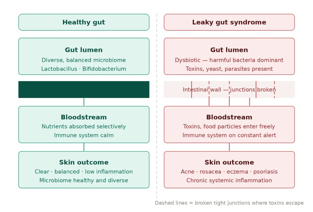 leaky gut syndrome and acne connection diagram