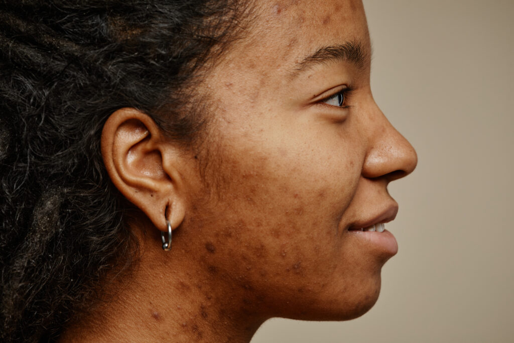 Post-inflammatory hyperpigmentation causing dark spots after acne in darker skin tones