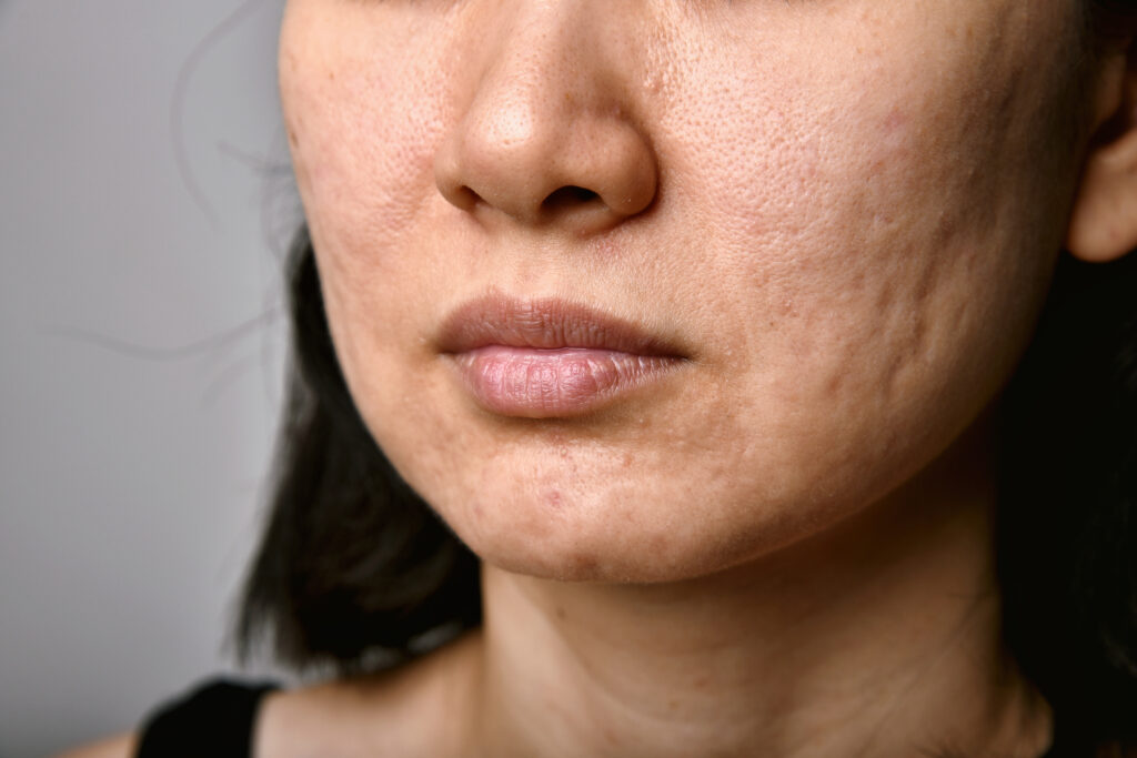 Acne scars on the cheek of a woman with darker skin tone