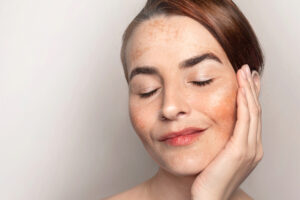 Woman with melasma on her cheeks demonstrating facial hyperpigmentation for comparison with post-inflammatory hyperpigmentation (PIH).