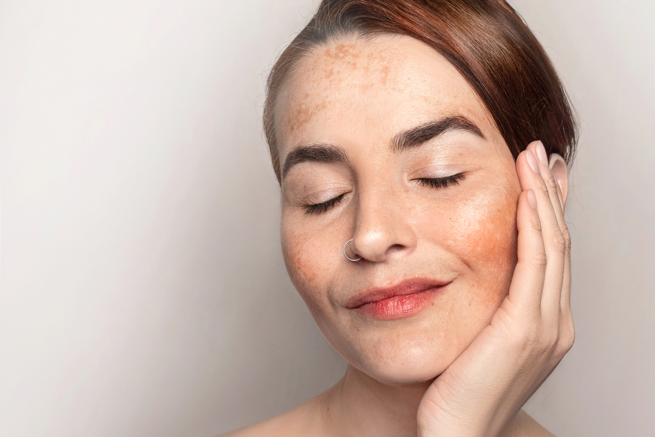 Woman with melasma on her cheeks demonstrating facial hyperpigmentation for comparison with post-inflammatory hyperpigmentation (PIH).