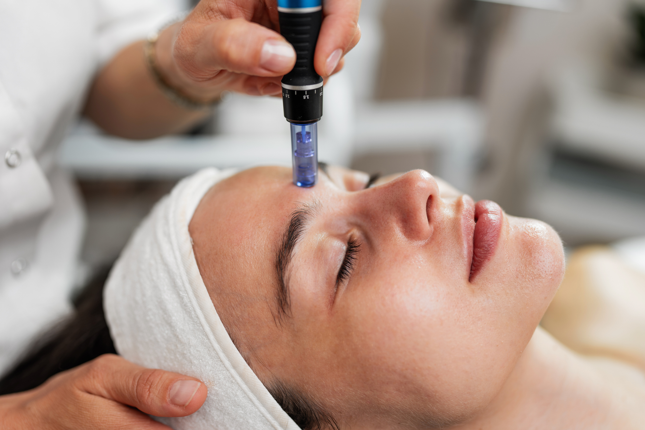 Microneedling with a chemical peel treatment at Celebrity Skin Scottsdale